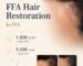 Frontal fibrosing alopecia hair transplant