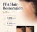 Frontal fibrosing alopecia hair transplant
