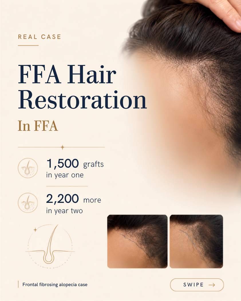 Frontal fibrosing alopecia hair transplant