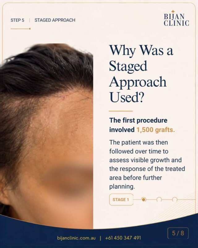 First stage of FFA hair restoration using 1,500 grafts