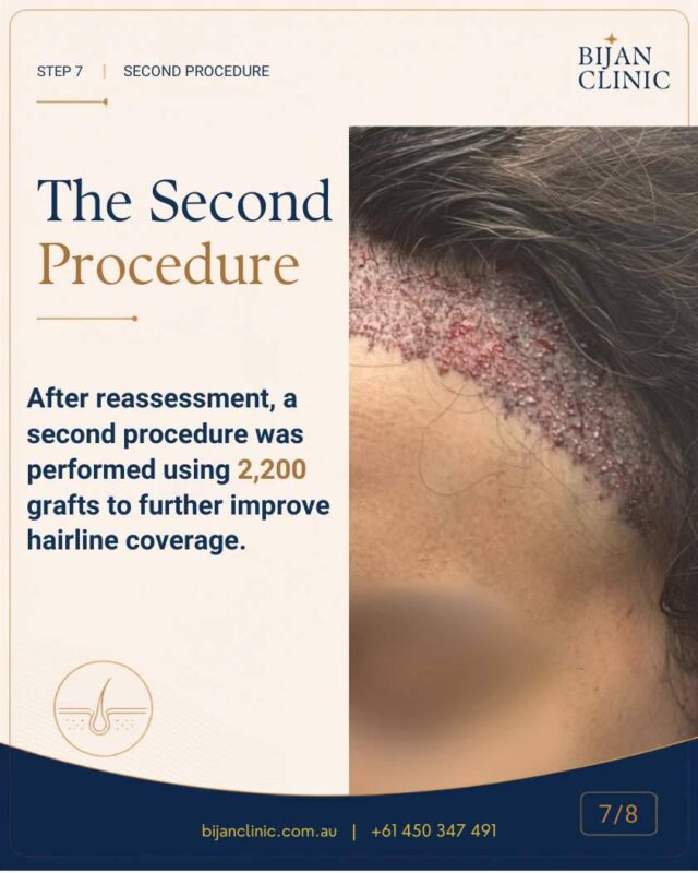 One-year visible hairline growth after the first 1,500-graft procedure