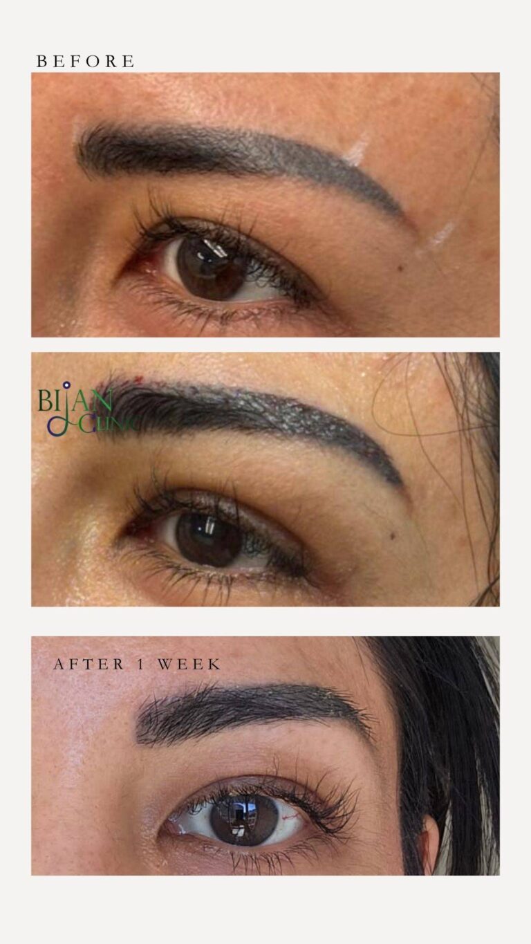 before- during transplant and after 2 weeks