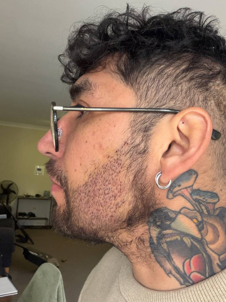 Two days after beard transplant procedure
