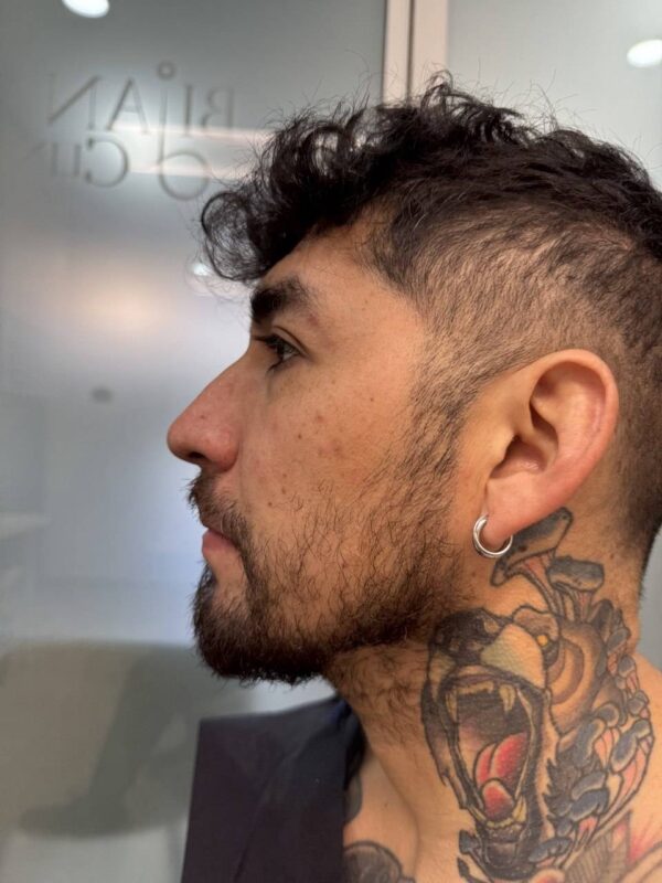 Immediate appearance after beard transplant