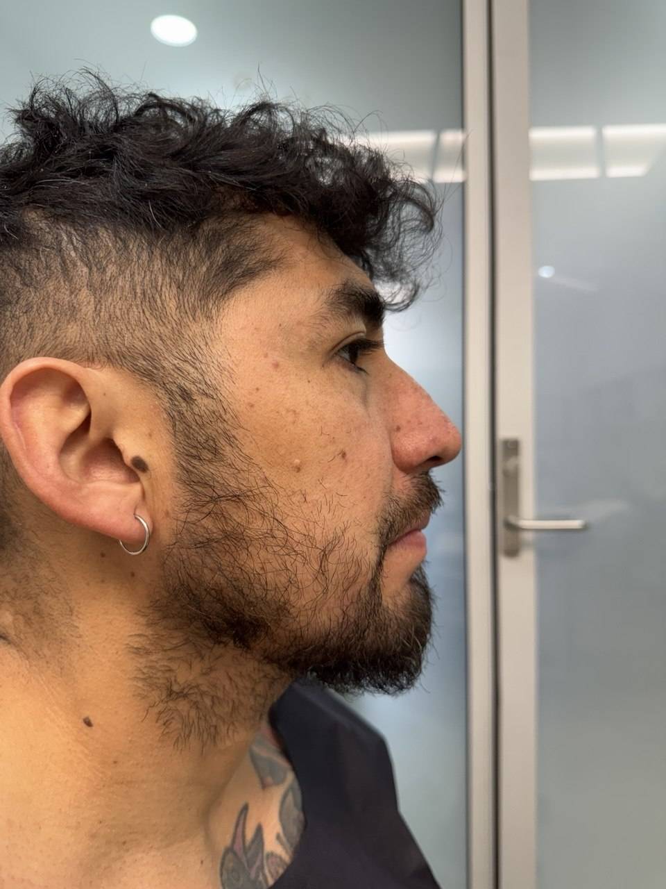 Before beard transplant treatment