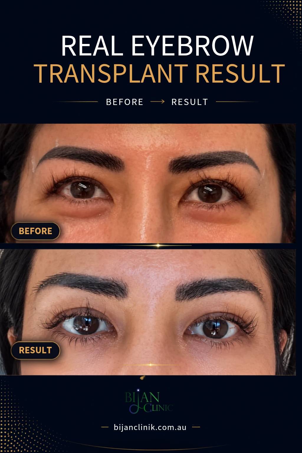 eyebrow transplant Sydney by Dr.BijanShabani