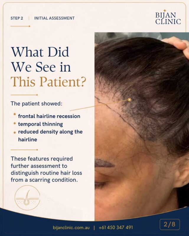 Frontal hairline recession and temporal thinning in a patient with FFA