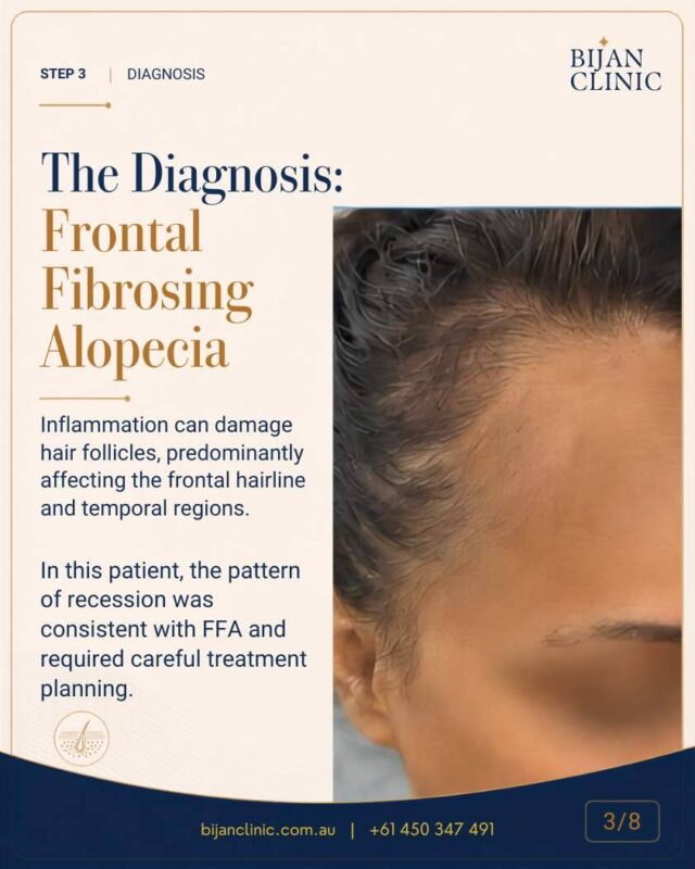 FFA hair transplant planning including donor area and long-term progression
