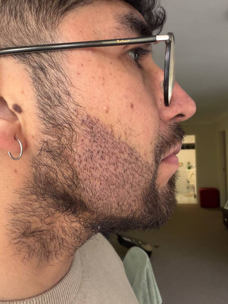 One week after beard transplant procedure