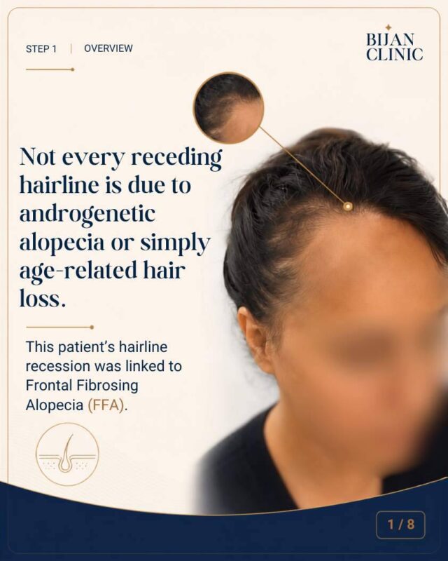 Female patient with frontal hairline recession linked to FFA