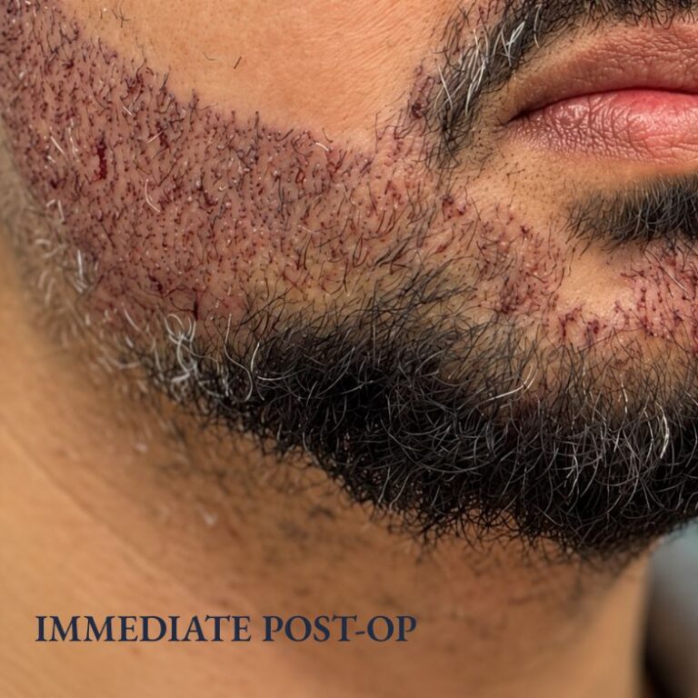 After beard transplant