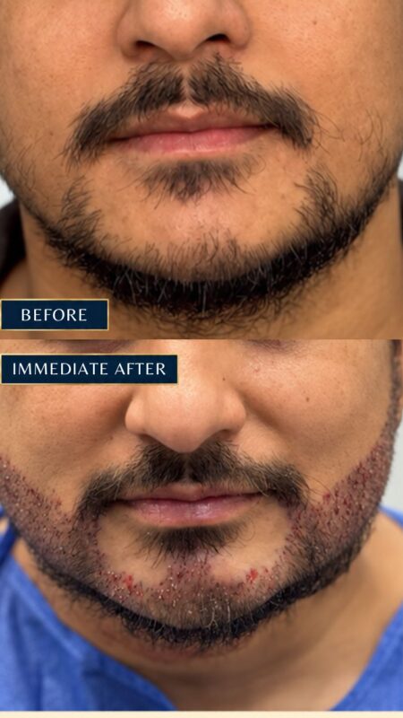 Beard transplant from Nepal