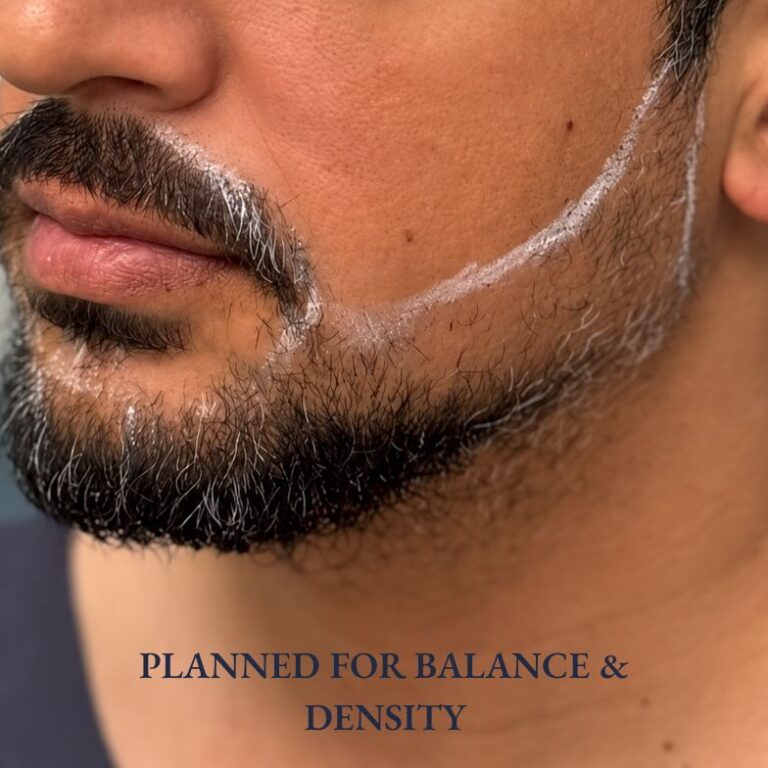 Dr.Bijan Design Beard before transplant