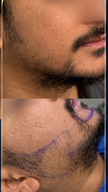 Nepalian face Beard transplant in Sydney