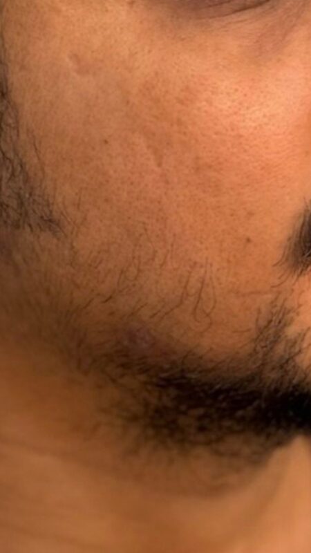 beard before transplant