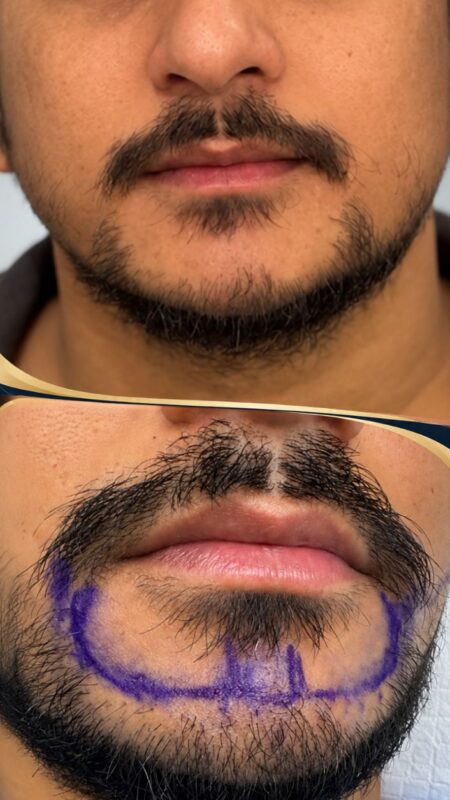 before and after beard transplant
