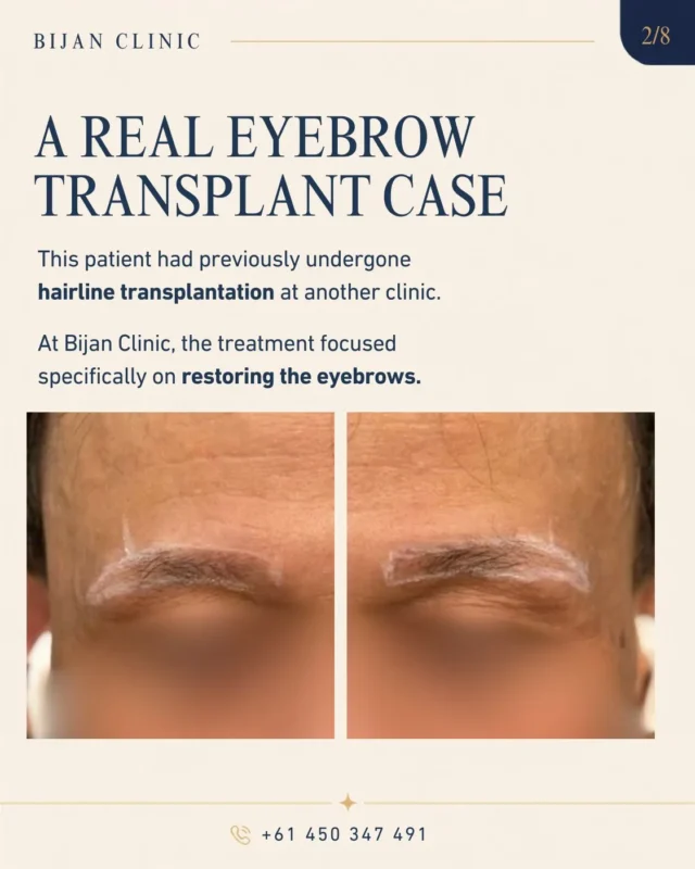 Eyebrow shape marked before hair transplantation