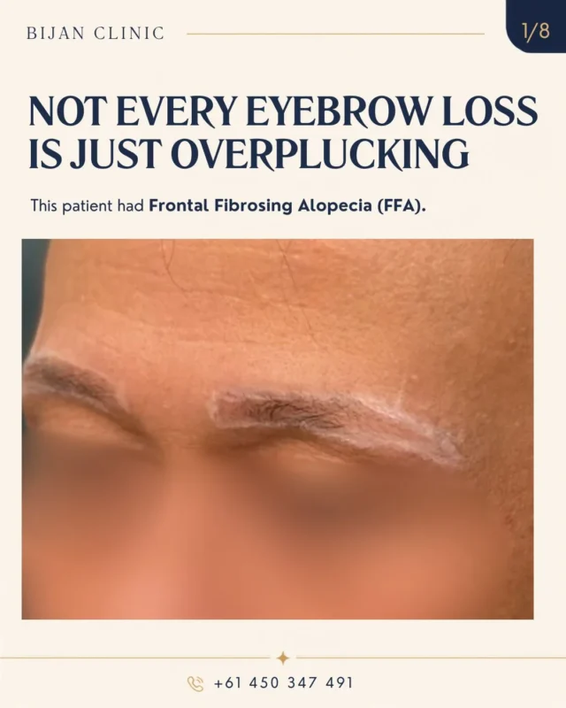 The eyebrow shape was planned before graft placement.