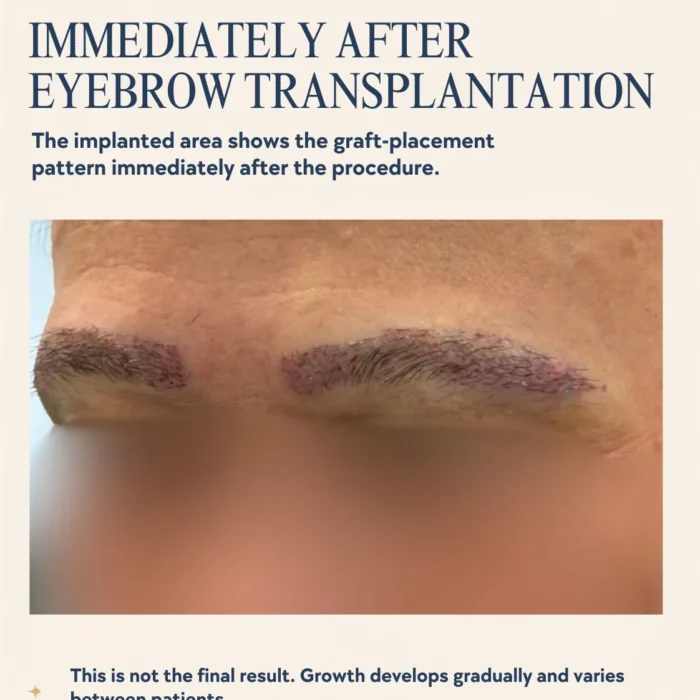 Eyebrow thinning in a patient with frontal fibrosing alopecia