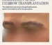 Eyebrow thinning in a patient with frontal fibrosing alopecia
