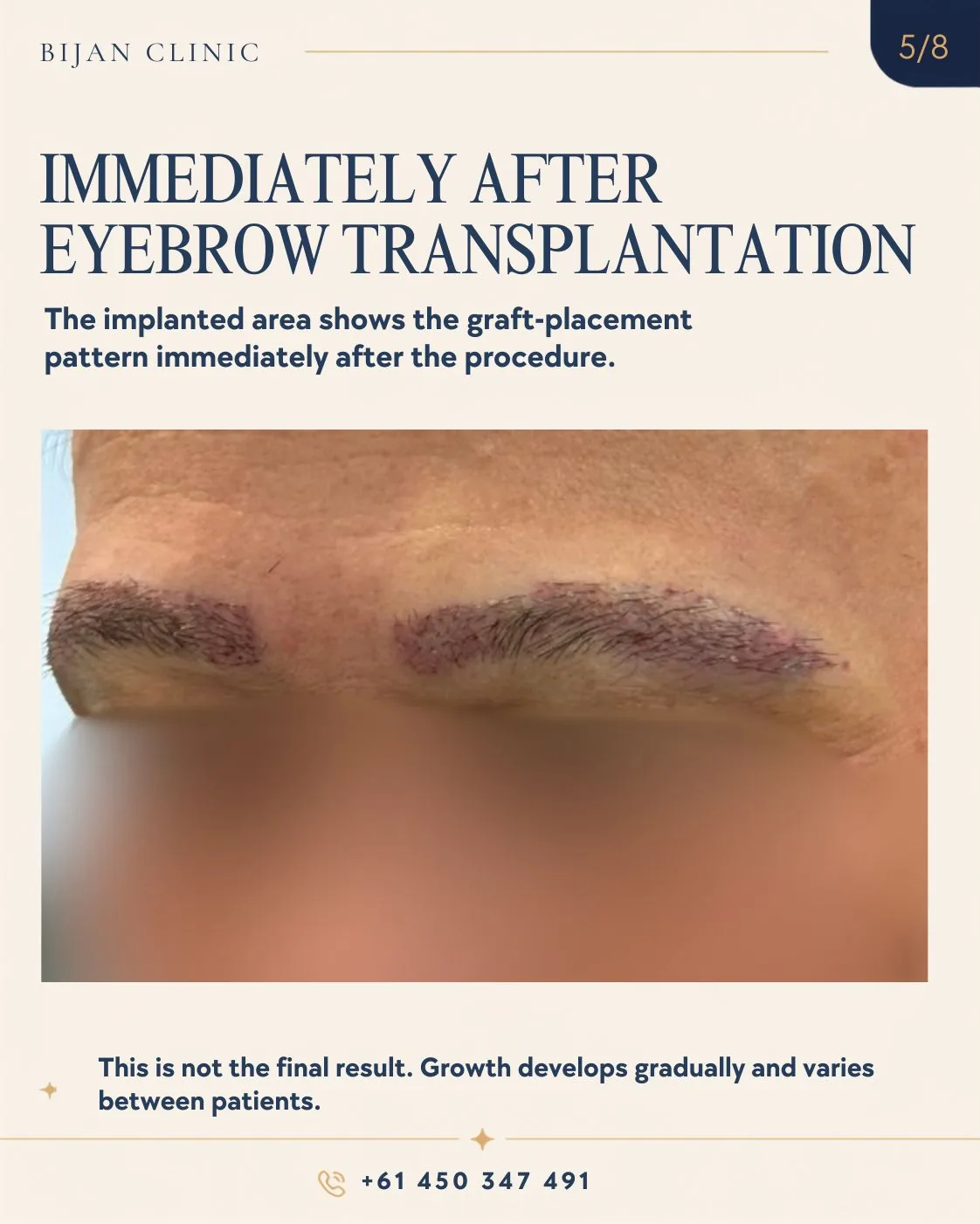 Eyebrow thinning in a patient with frontal fibrosing alopecia